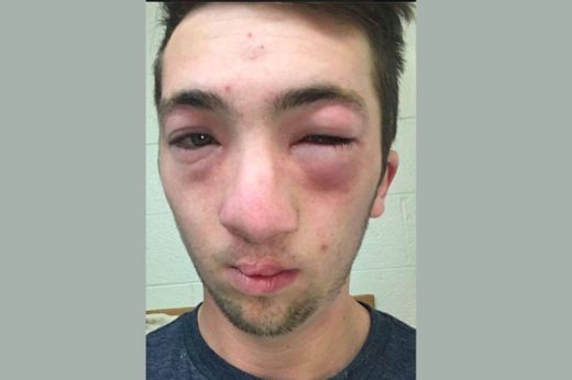 แพ้อาหารไม่ใช่เรื่องล้อเล่น! หนุ่มหน้าบวมปูดเหตุถูกละเลงเนยถั่ว