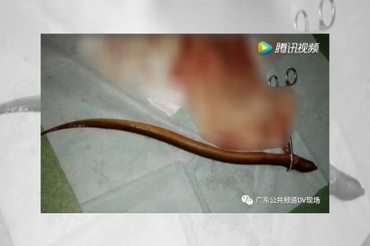 ทำไปได้! ชายไส้ทะลุหวิดกับ หลังใช้ปลาไหลยัดทวารรักษาท้องผูก