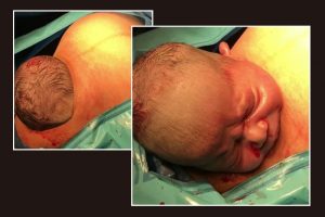 คลิปทารกน้อยลืมตาดูโลกด้วยวิธีผ่าคลอดเลียนแบบธรรมชาติ