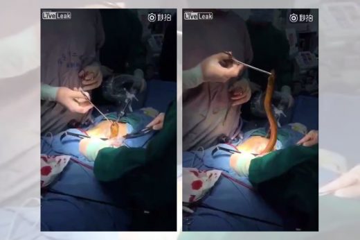 อี๋ แพทย์ผ่าตัดปลาไหลเป็น ๆ จากตัวคนไข้ พลัดหลุดเข้าไปทางรูก้น!?