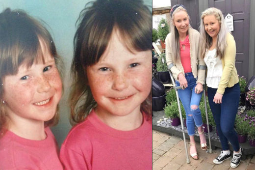 พี่น้องฝาแฝดป่วยโรคหายาก ร่างกายค่อย ๆ กลายเป็นกระดูกขยับไม่ได้