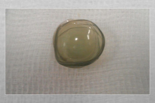 จักษุแพทย์ผงะ พบคอนแทคเลนส์ 27 ชิ้น ค้างเติ่งในลูกตาคนไข้!