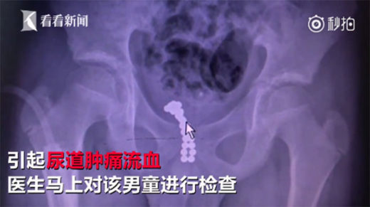 อุทาหรณ์! หมอผ่าตัดลูกเหล็กแม่เหล็ก 26 เม็ดออก หลังเด็กชายยัดเข้าร่างกายทางจุ๊ดจู๋