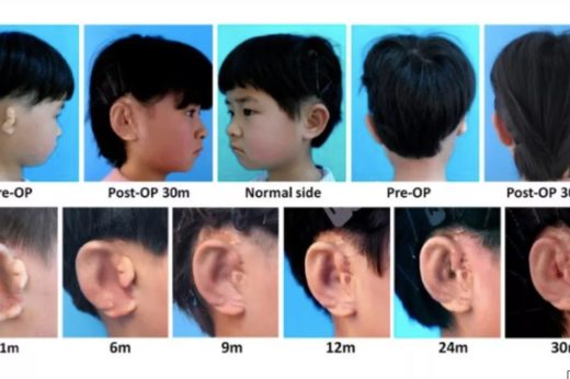 นักวิทย์ฯ จีนประสบความสำเร็จในการปลูกถ่ายหูใหม่ ด้วยการเพาะเซลล์ในแม่พิมพ์ 3D